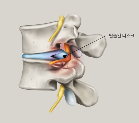 허리디스크