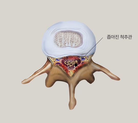 척추관협착증