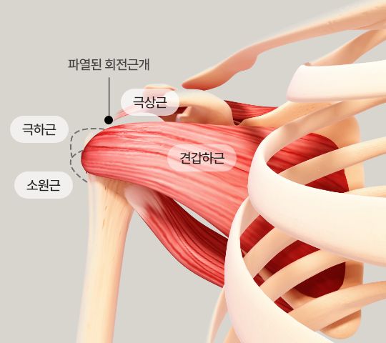 회전근개파열
