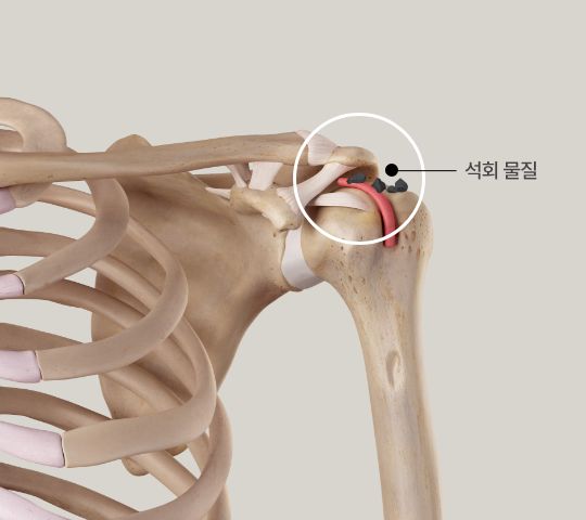 석회성건염